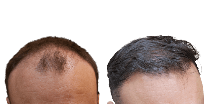 włosy przed i po zabiegu